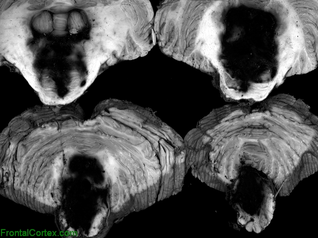 Pontine Hemorrhage, multiple transverse sections through brainstem and cerebellum